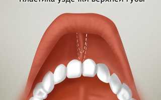 Может ли пластика уздечки верхней губы решить эстетические и функциональные проблемы рта