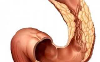 Аденокарцинома