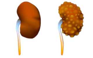 Редкие почечные аномалии: как лечить мультикистозную дисплазию