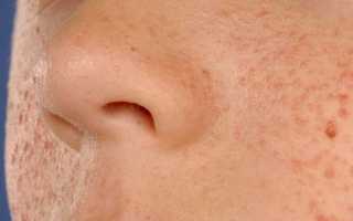 Что такое туберозный склероз, причины возникновения, симптомы и лечение заболевания