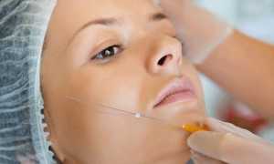 Мезонити или филлер: что лучше для устранения носогубных складок по отзывам пациентов