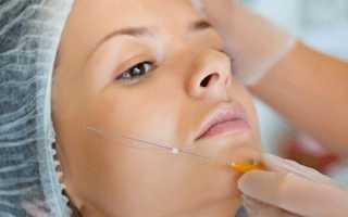 Мезонити или филлер: что лучше для устранения носогубных складок по отзывам пациентов