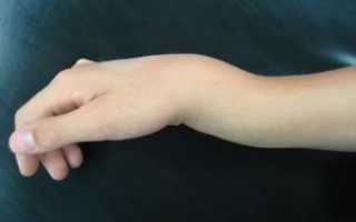 Непонятные ощущения в области перелома