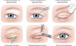 Реабилитация после блефаропластики — все о правилах ухода за глазами и возможных осложнениях