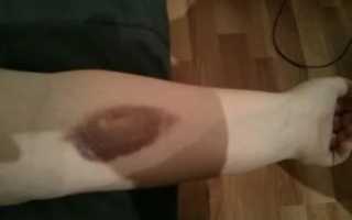 Мимо вены ввели препарат, что делать?