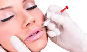 Увеличение губ гиалуроновой кислотой — особенности процедуры о которых важно знать