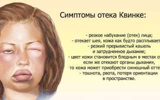 Отек Квинке