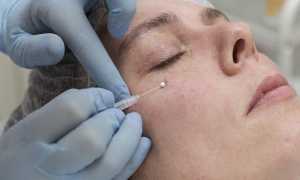 Эффективны ли мезонити под глаза, кому подойдет эта процедура