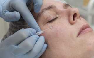 Эффективны ли мезонити под глаза, кому подойдет эта процедура