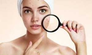 Можно ли делать чистку лица при беременности, какой вид очищения самый безопасный