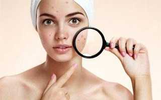 Можно ли делать чистку лица при беременности, какой вид очищения самый безопасный