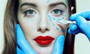 Круговая блефаропластика — можно ли выглядеть на 10 лет моложе после одной операции