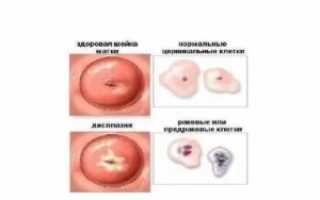 В чём разница между дисплазией и лейкоплакией?