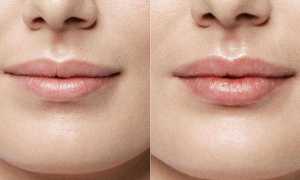 Неровные губы после увеличения — причины и способы устранения проблемы