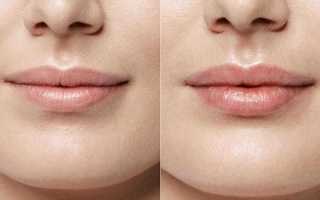 Неровные губы после увеличения — причины и способы устранения проблемы