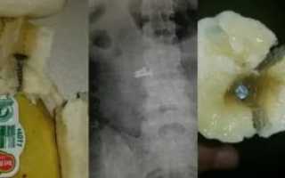 Нечаянно проглотила пломбу, это не опасно?