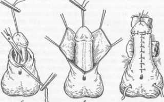 Спайка на половом члене