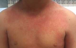 Острая ревматическая лихорадка у детей