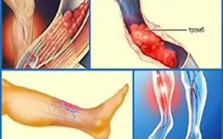 Тромбофлебит