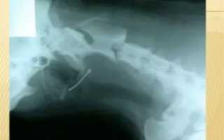 Могла ли застрять косточка в горле в пищеводе?