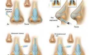 Какие проблемы помогут исправить уколы ботокса в нос