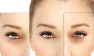 Может ли инъекционная блефаропластика быть заменой хирургическому вмешательству