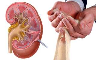 Профилактика и лечение почечного песка