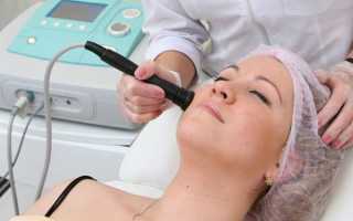 Аппараты для rf-лифтинга в домашних условиях: как выбрать лучший