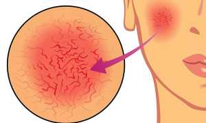 Какой пилинг можно использовать при куперозе — самые безопасные варианты