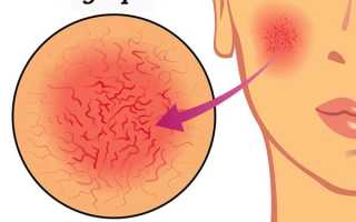 Какой пилинг можно использовать при куперозе — самые безопасные варианты