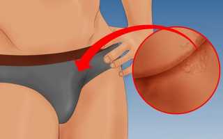 Что делать, если на головке пениса появились наросты