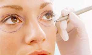 Какие проблемы поможет решить кантопластика и не опасна ли эта процедура