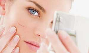 Шлифовка рубцов: как выполняется, в каком случае можно добиться заметного эффекта