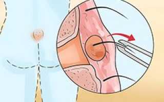 Киста копчика