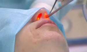 Лазерная ринопластика: отличия от традиционной операции, плюсы и минусы