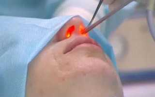 Лазерная ринопластика: отличия от традиционной операции, плюсы и минусы