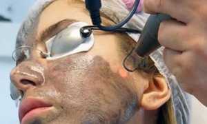 Что такое карбоновый пилинг и правда ли он эффективен