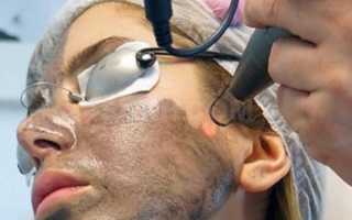 Что такое карбоновый пилинг и правда ли он эффективен