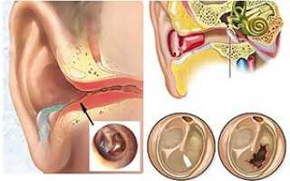 Экссудативный отит