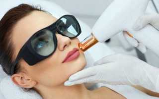 Лазерная шлифовка — какой эффект дает эта крайне болезненная процедура