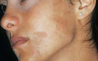 Мезотерапия от пигментных пятен: суть процедуры и особенности проведения