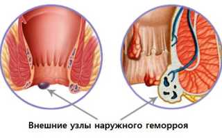 Лечение геморроя эффективными средствами