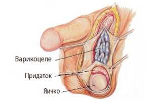 Что такое варикоцеле и как его лечить