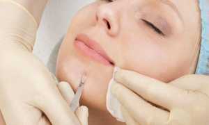 Что лучше — механическая, ультразвуковая, атравматическая или вакуумная чистка лица