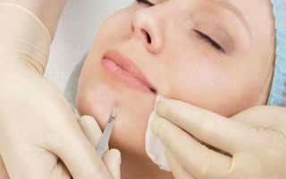 Что лучше — механическая, ультразвуковая, атравматическая или вакуумная чистка лица