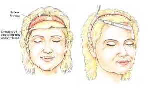 Кому и когда нужно делать фронтопластику лба, отзывы косметологов и пациентов