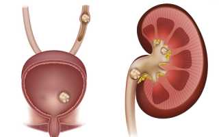 Разновидности почечных камней и методики их лечения