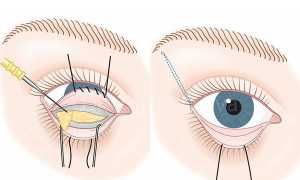 Трансконъюктивальная блефаропластика — все особенности коррекции области век