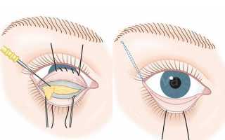 Трансконъюктивальная блефаропластика — все особенности коррекции области век