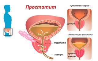 Терапия простатита в домашних условиях